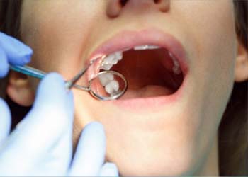 Wisdom Tooth Removal in Dholka